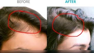 Watch à¤—à¤¿à¤°à¤¤à¥‡ à¤Ÿà¥‚à¤Ÿà¤¤à¥‡ à¤¬à¤¾à¤²à¥‹à¤‚ à¤•à¤¾ à¤‡à¤²à¤¾à¤œ | DIY Hair Growth Serum | How To Get Thick Hair & Reduce Hair Fall Video