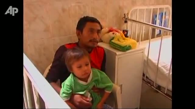 Watch Parasitic Twin to Be Removed From 3-year-old Video
