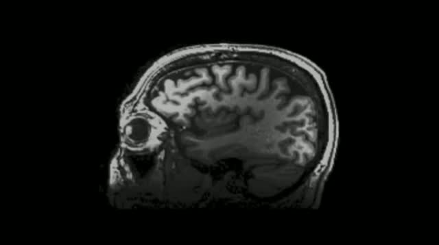 Watch New MRI Reveals Mysteries of Brain Injuries Video