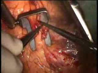 Watch HEART SURGERY WATCH Video