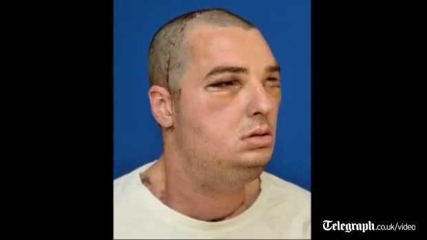 Watch US gun injury victim receives 'most extensive full face transplant ever' video Video