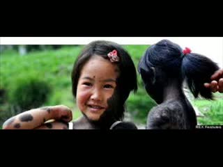 Watch Girl Covered With Thick Black Fur Is Abandoned By Family Video