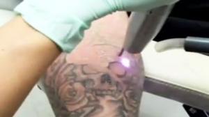 Watch Amazing Half Sleeve Laser Tattoo Removal Video