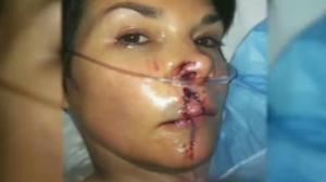Watch Interview With The News Anchor Who Was Bitten by a Dog Video