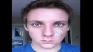 Watch Guy Documents Face Healing After Bar Fight Video
