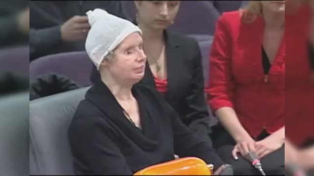 Watch Chimp Attack Victim Speaks to CT Lawmakers Video