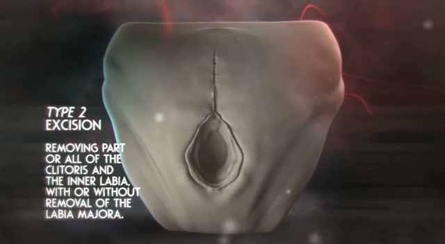 Watch Female Genital Mutilation - Animation of what happens Video