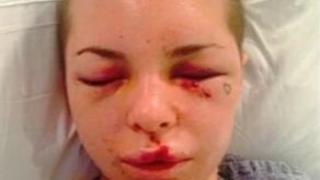 Watch Pictured Po*n star posts images of horrific injuries after 'barely escaping enraged MMA fighter boy Video