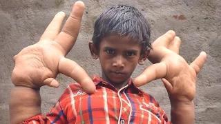 Watch Mystery Condition Gives Indian Boy Gigantic Hands Video