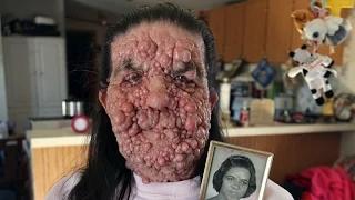 Watch Bubble Gran, Woman Covered In Benign Tumours: Body Bizarre Episode 5 Video