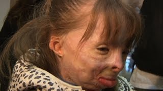 Watch Girl Who Survived Fire Receives Christmas Cards Video