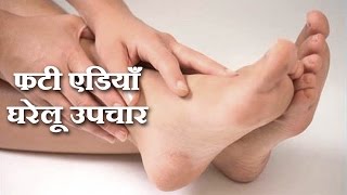 Watch Cracked Heels Remedies in Hindi by Sonia Goyal Video