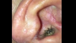 Watch Ants coming out of 12 yr old girl's ear every day in Ahmedabad, doctors shocked Video