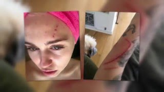 Watch Miley Cyrus Gets Nasty Scratch Wounds Video