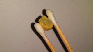 Watch Popping Pus Filled Throat Boulders Video