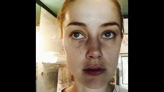 Watch Photos Show Amber Heard's Injuries Allegedly Caused by Johnny Depp in Another Domestic Video