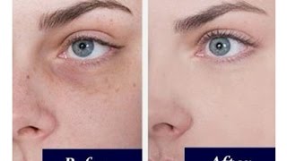 Watch How to hide/cover under eye hollowness and dark circle and look younger instantly without botox. Video