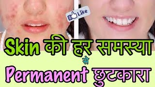 Watch How to Remove Pimples PERMANENTLY at home - Acne Treatment for Glowing Clear Skin Video