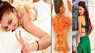 Watch Urvashi Rautela Undergoes Painful Cupping Therapy | Urvashi Rautela Undergoes Painfu treatment Video