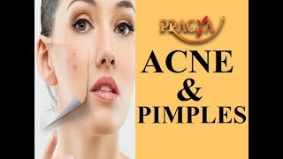 Watch Get Rid of Acne & Pimples Payal Sinha (Naturopath Expert) Video