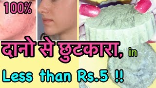 Watch DIY Natural Acne Treatment - Remove Pimples Permanently | JSuper Kaur Video