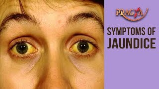 Watch Symptoms of JAUNDICE Dr. Rajat Jhamb (Consultant Physician) Video