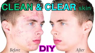 Watch Boys Special - DIY Astringent for Clear, Spotless Skin | Get rid of Pimples, Open Pores Video