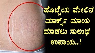 Watch Home Remedies for Stretch Marks | Top Kannada Health Tips | Top Kannada TV Video
