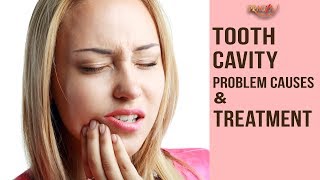 Watch Tooth Cavity- Problem, Causes & Treatment | Dr. Arunima Singhal Video