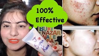 Watch How To Remove Pimples - DIY Neem Face Wash | Teenage Skin Care | Pimples Remedy | Jsuper Kaur Video