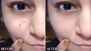 Watch How to Remove Pimples - 100% Effective Acne treatment | JSuper Kaur Video