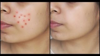 Watch How to : Get Rid of Acne Permanently | All about Skincare Series - 1 Video
