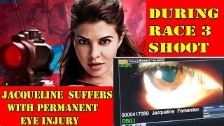 Watch Jacqueline Fernandez Suffers With Permanant EYE Injury During RACE 3 Shoot Video