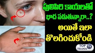 Watch à°ªà±à°²à±à°ªà°¿à°°à°¿à°•à°¾à°¯à°²à± à°¤à°—à±à°—à°¾à°²à°‚à°Ÿà±‡ à°ˆ à°šà°¿à°Ÿà±à°•à°¾ à°ªà°¾à°Ÿà°¿à°‚à°šà°‚à°¡à°¿ | Home Remedies to Get rid of Warts | Telugu Health Tips Video