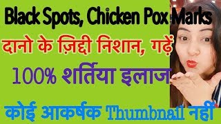 Watch DIY Bio Oil/No Marks cream - à¤¦à¤¾à¤—à¤¼ à¤§à¤¬à¥à¤¬à¥‡ à¤®à¤¿à¤Ÿà¤¾à¤à¤ - Remove Acne Scars Naturally 100% | JSuper Kaur Video