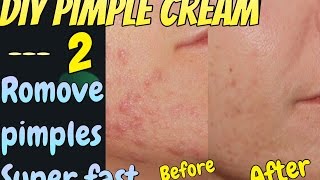 Watch How to Remove Pimples FAST | Get Clear Whitening Skin | DIY Acne Treatment Video