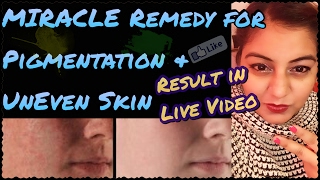 Watch Home Remedy for Pigmentation | How to Remove Black Spots and Dark Spots on Face Video