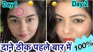 Watch DIY Acne Treatment in 1 day | How to Remove Pimples Overnight | 100% Natural | JSuper Kaur Video
