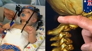 Watch Head reattached after decapitation: Toddler's skull fused to spine after car crash Video