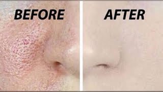 Watch How to Get Rid Of Pimple/Acne Pits & Open Pores | Shrink Large Pores | 100% Effective | JSuper Kaur Video
