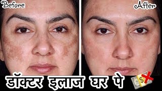 Watch Remove Dark Spots, Pigmentation - Doctor Treatment at Home  | How To get Clear Skin | JSuper Kaur Video