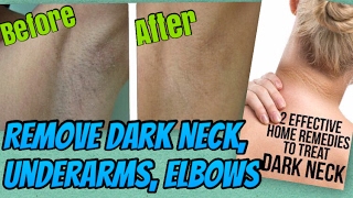 Watch How to Lighten Dark Underarms & Dark Neck at Home | Home remedy to get Rid of Dark underarms & Neck Video