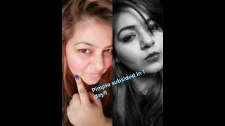 Watch How to Remove Pimples in 1 day/OVERNIGHT | MAGIC GLOW | ACNE TREATMENT | REMOVE Acne SCARS | Video