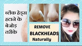 Watch How to Remove BLACKHEADS / WHITEHEADS in 1 APPLICATION | 100% works | NATURAL remedy | JSuper Kaur Video
