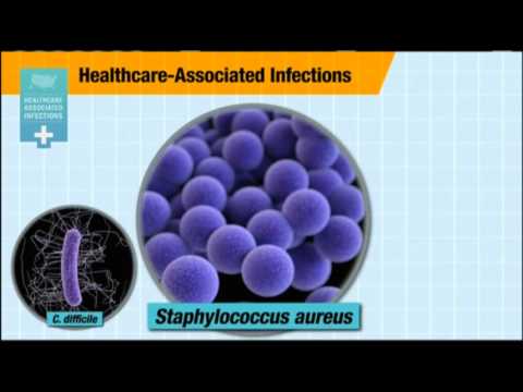 Watch CDC- One in 25 Hospital Patients Has Infection News Video Video