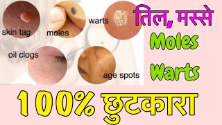 Watch Natural Remedy to Remove Moles, Warts, Pimples, Acne, Age Spots | 100% EFFECTIVE | JSuper Kaur Video