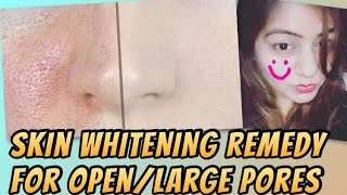 Watch DIY NATURAL Skin Whitening Cubes for Open Pores | How to get rid of Open/Large pores | JSuper Kaur Video