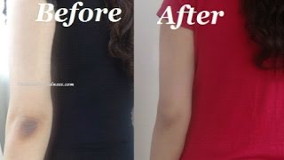 Watch How to Get Rid of Dark Elbows and Knees Quickly Video